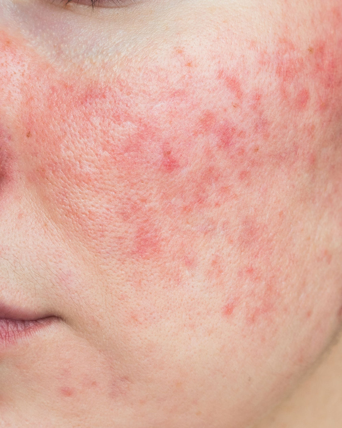 How to Treat Rosacea Quickly