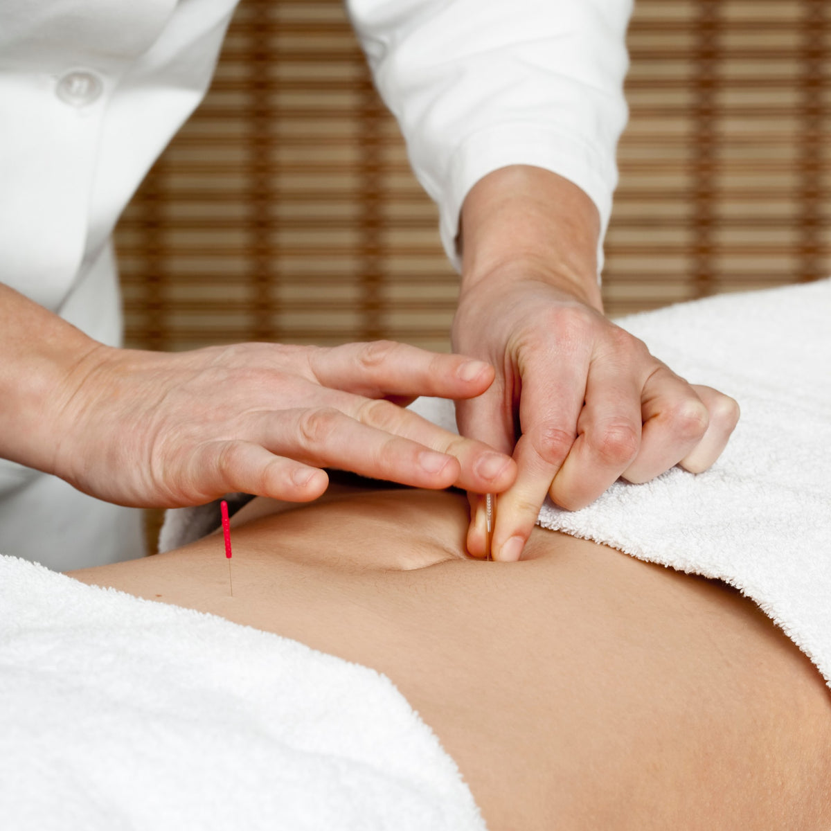 Practitioner placing acupuncture needles during an abdominal treatment