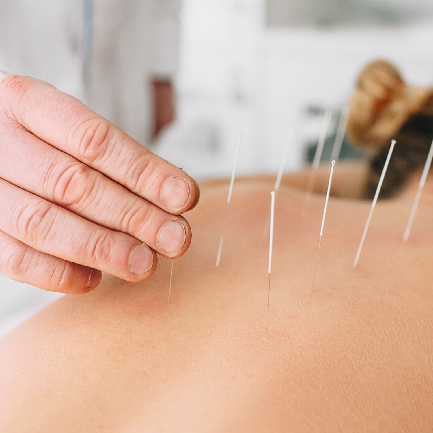 Acupuncture needles placed along the upper back during a Chinese medicine treatment
