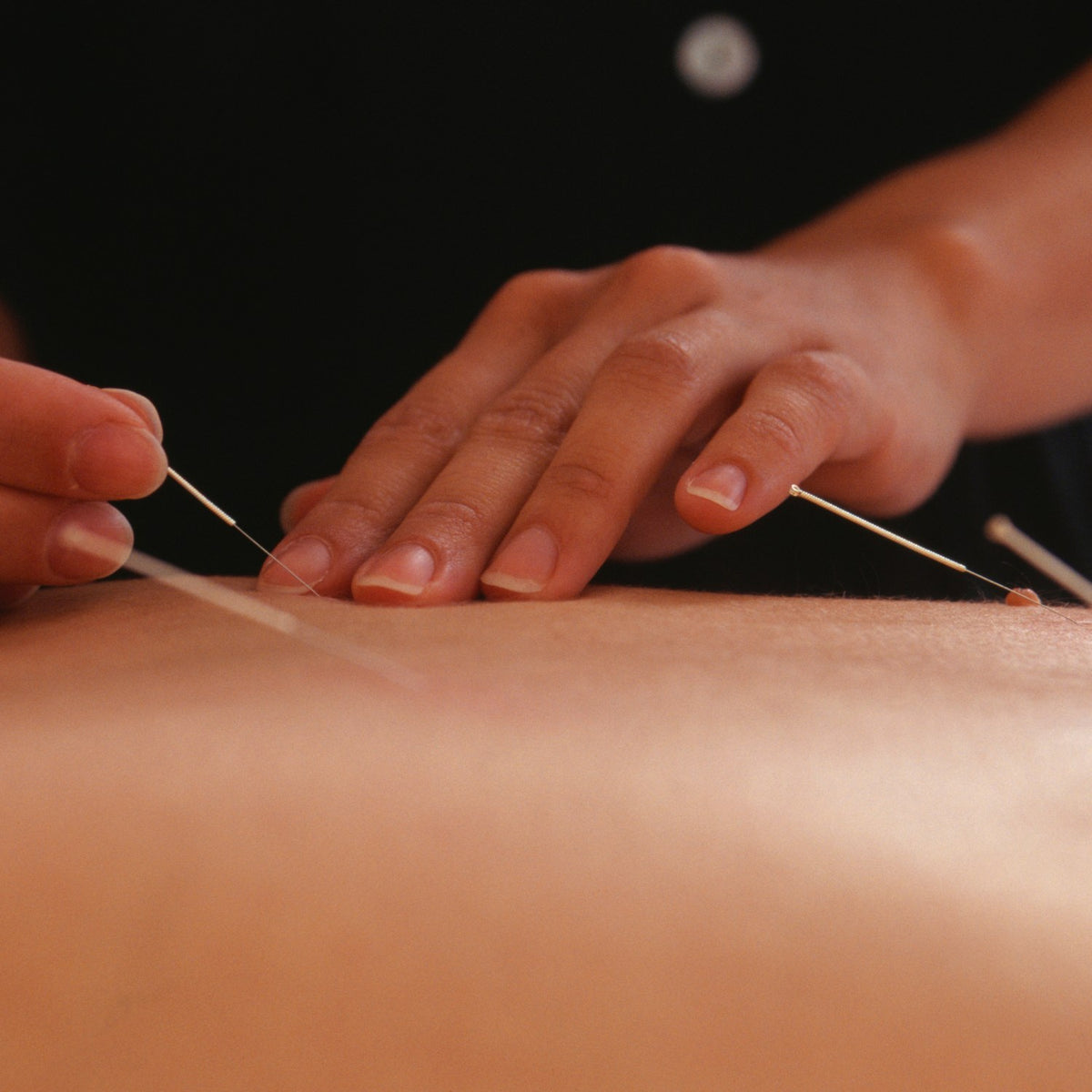 Acupuncture needles being placed along the back during a Chinese medicine treatment