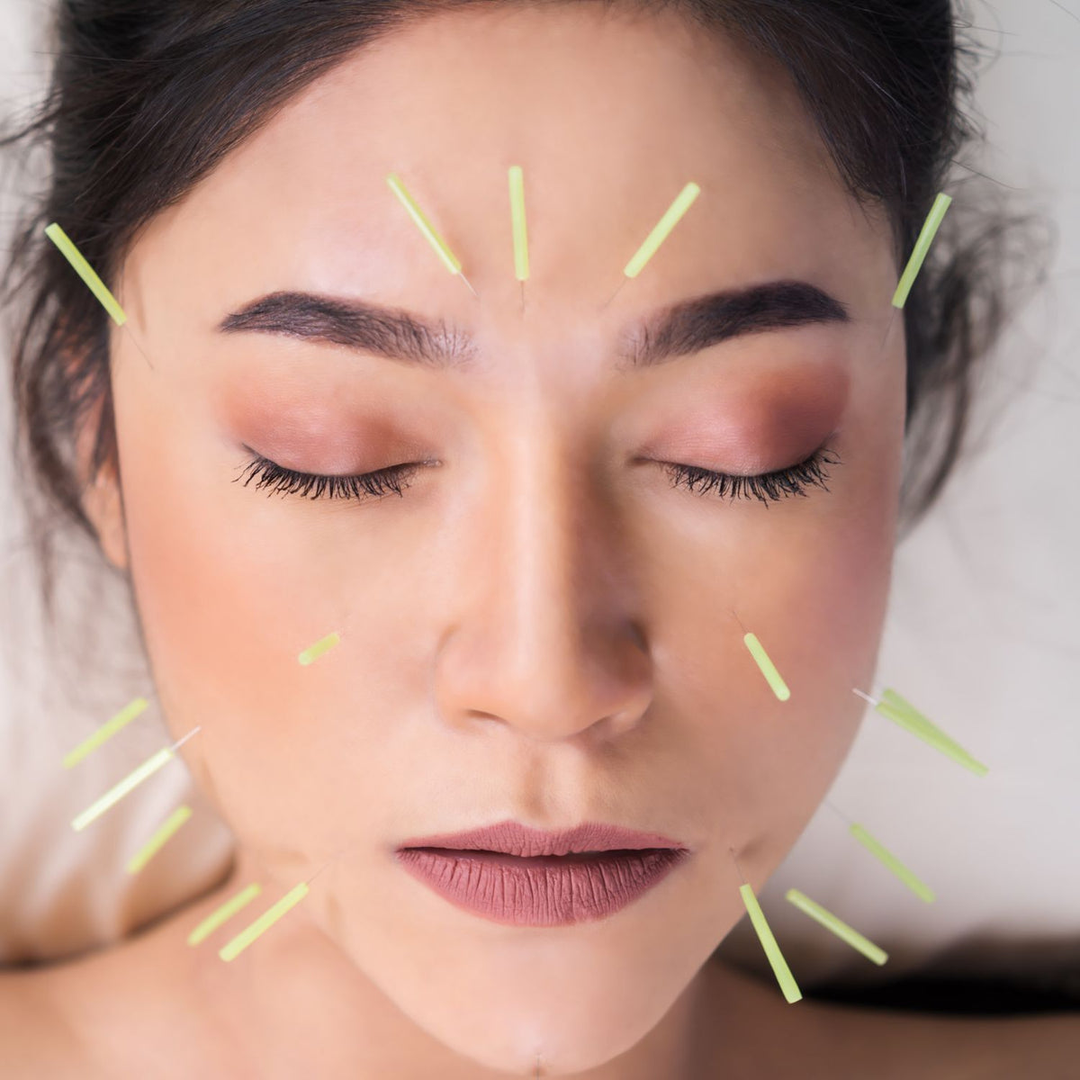 Fine cosmetic acupuncture needles placed across the forehead and cheeks