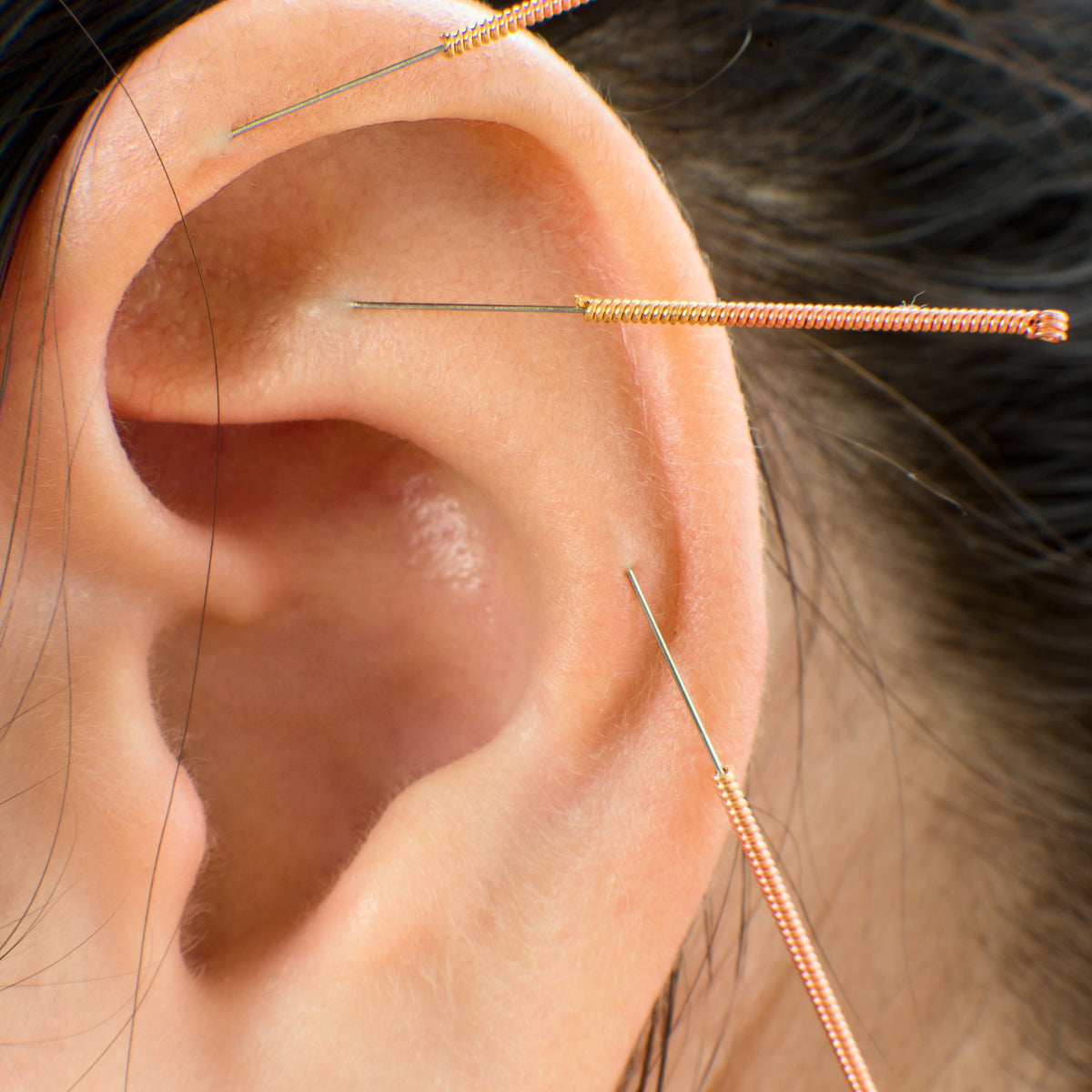 Auricular acupuncture needles placed in the ear