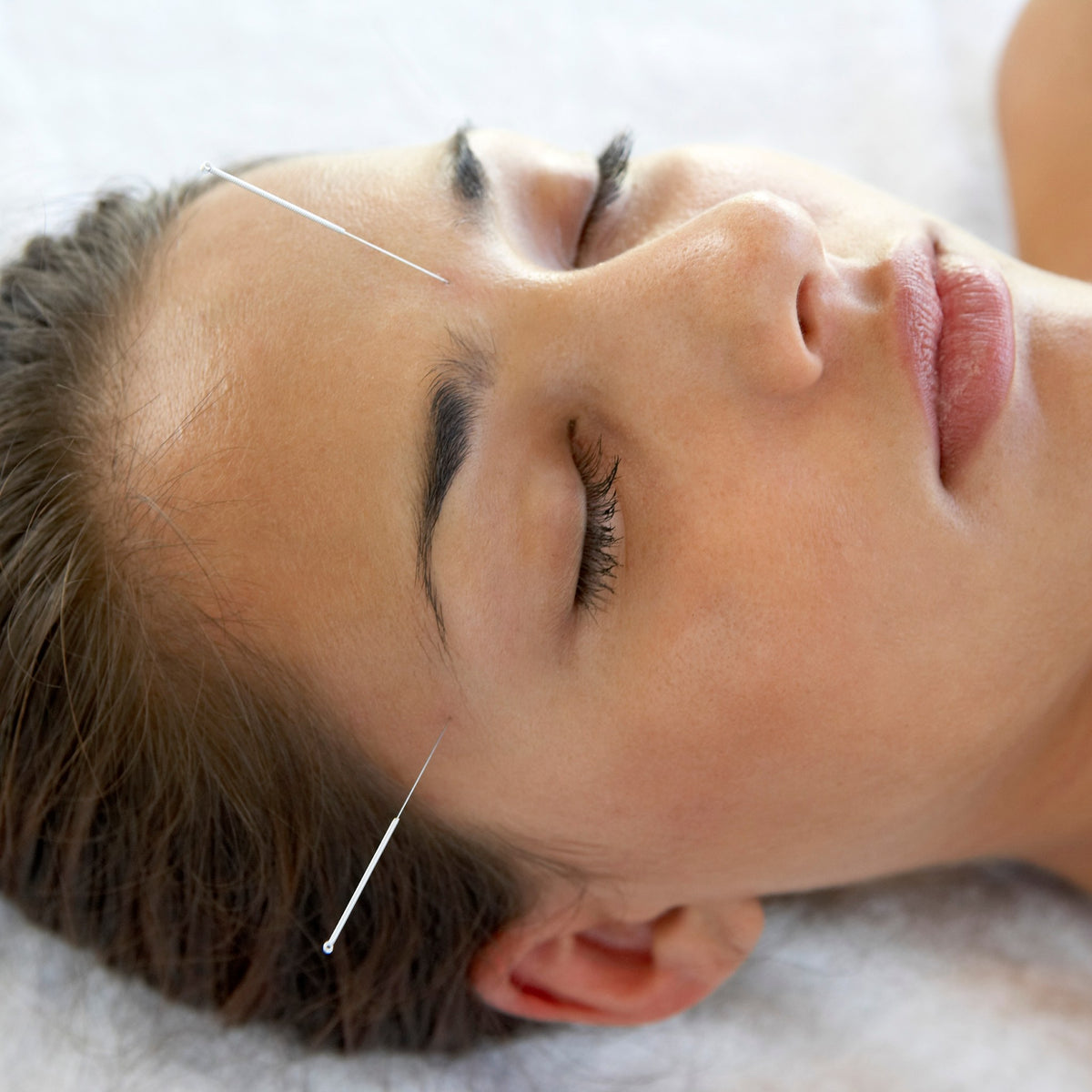 Fine acupuncture needles placed at the forehead and temple during a facial treatment
