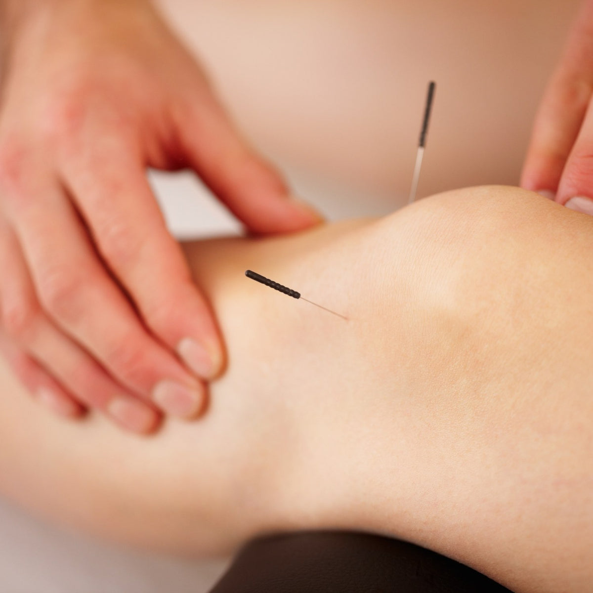 Acupuncture needle placed at the knee during a treatment for musculoskeletal pain