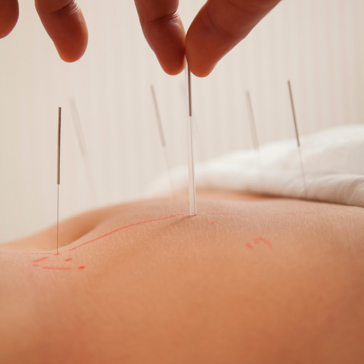 Acupuncture needles placed in the lower back during a treatment